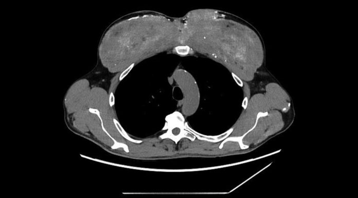 Ін’єкції синтолу, пов’язані з серйозним кальцієвим розладом: відстрочені ускладнення