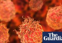 Průlomová imunoterapie ukazuje slibné výsledky u pokročilého karcinomu prostaty