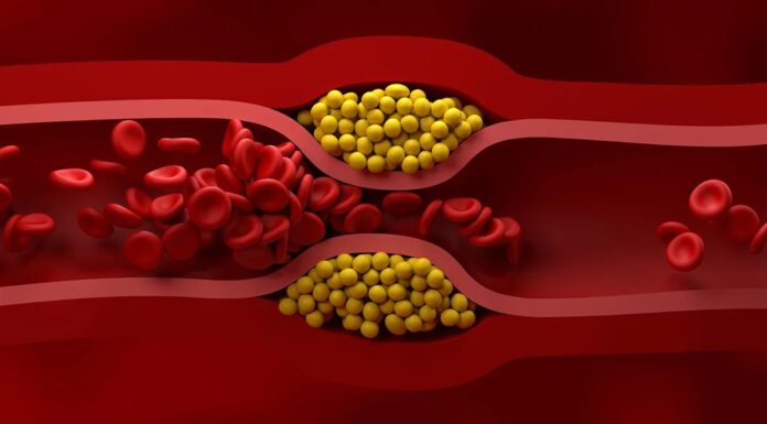 Оновлені рекомендації щодо холестерину: попереджувальна профілактика для кращого здоров’я серця