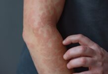 Кератин може діяти як «гальмо» для запалення шкіри, що вказує на можливі методи лікування