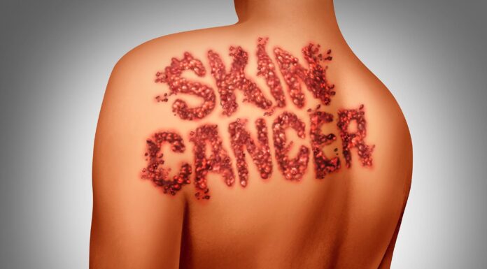 250 New Genes Could Rewrite How We Stop Melanoma